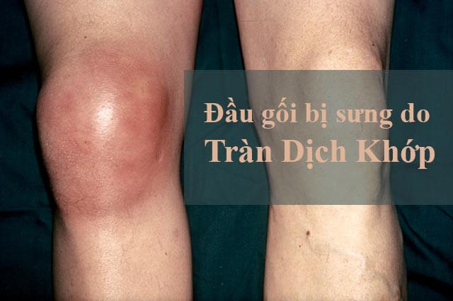 Đầu gối bị sưng do bị tràn dịch khớp gối